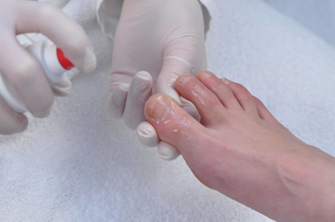 Spray zur Behandlung von Nagelpilz