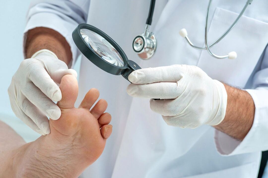 Der Arzt untersucht die Füße mit dem Pilz