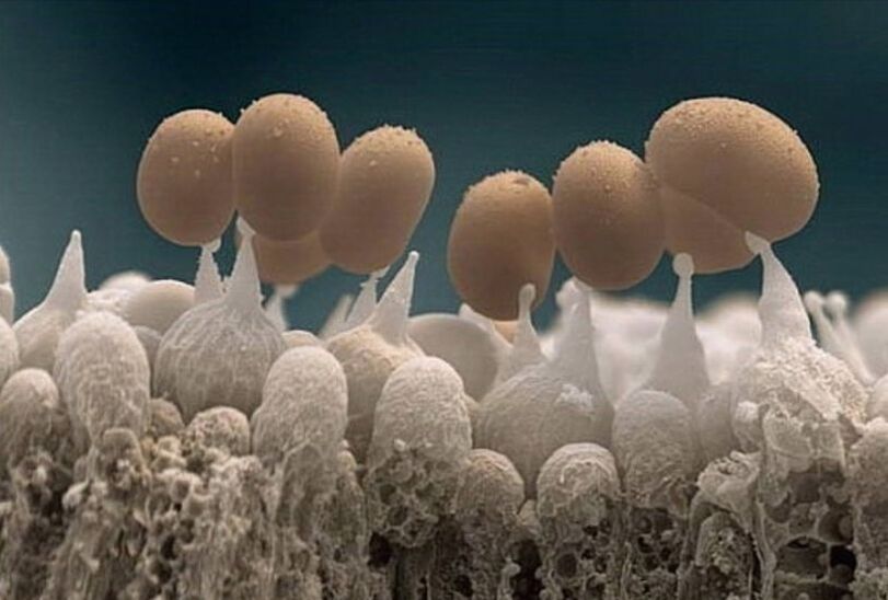 Zehennagelpilz unter dem Mikroskop