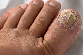 Foto des Nagelpilzes