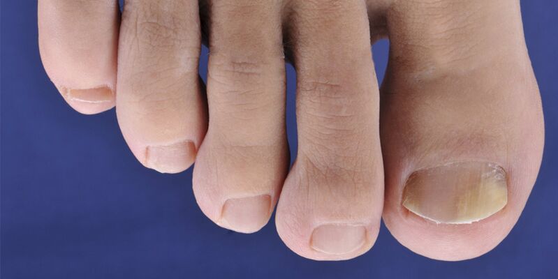 Symptome von Haut- und Nagelplatten