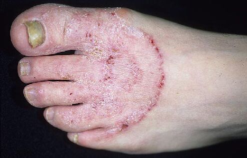 Füße und Nagelpilze