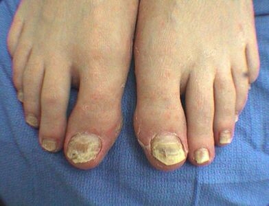 Symptome von Nagelpilzen