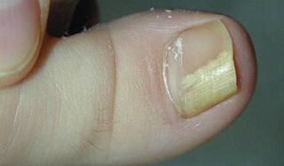 Anzeichen und Symptome des Nagelpilzes