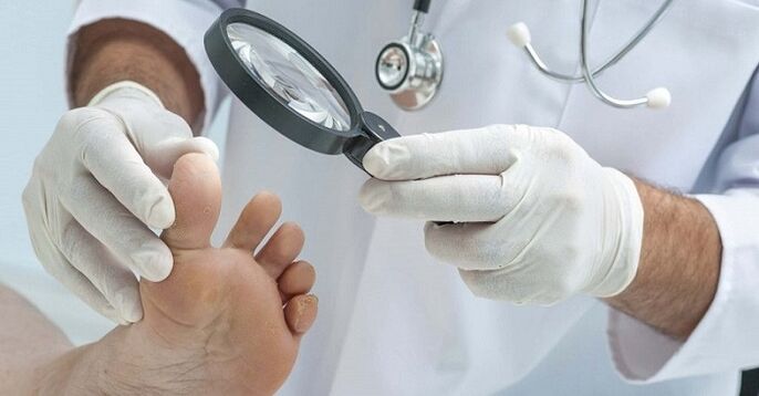 Der Arzt untersucht die Füße auf Nagelpilz
